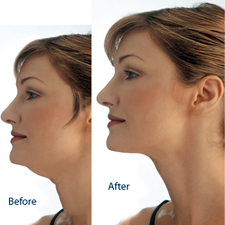 Female Cosmetic Plastic Surgeon, Chicago, Glenview, Highland Park, North Shore, Liposuction, Breast Augmentation, Breast Implants, Breast Enhancement, Facelift, Tummy Tucks, Best Plastic Surgeons, Cosmetic Surgery, Botox, laser lipo, Cellulaze, Coolsculpting, Smartlipo, Fat reduction, www.casas.md Female Cosmetic Plastic Surgeon, Chicago, Glenview, Highland Park, North Shore, Liposuction, Breast Augmentation, Breast Implants, Breast Enhancement, Facelift, Tummy Tucks, Best Plastic Surgeons, Cosmetic Surgery, Botox, laser lipo, Cellulaze, Coolsculpting, Smartlipo, Fat reduction, www.casas.md