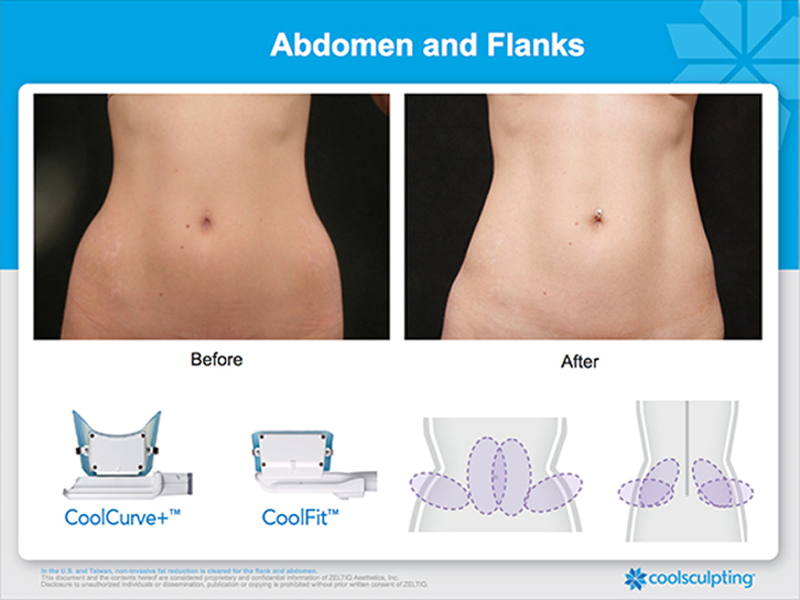 CoolSculpting - Upper & Lower Flanks Before & After Gallery - Case 4437