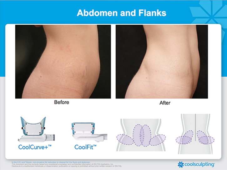 CoolSculpting® Upper Flanks