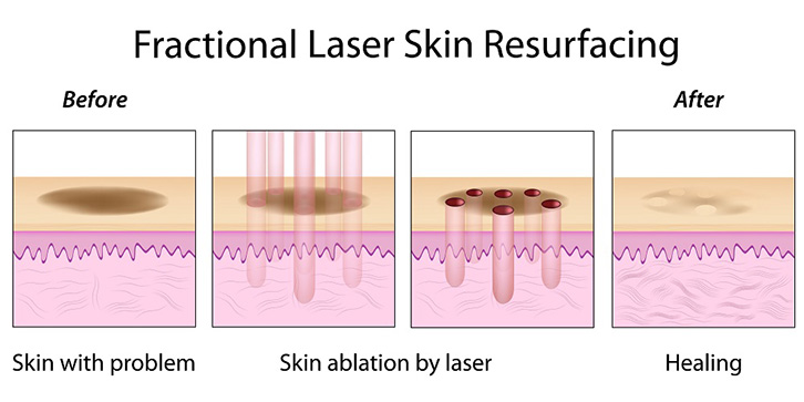 How Skin Resurfacing Works