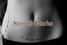 Stretchmark Tummy Tuck 