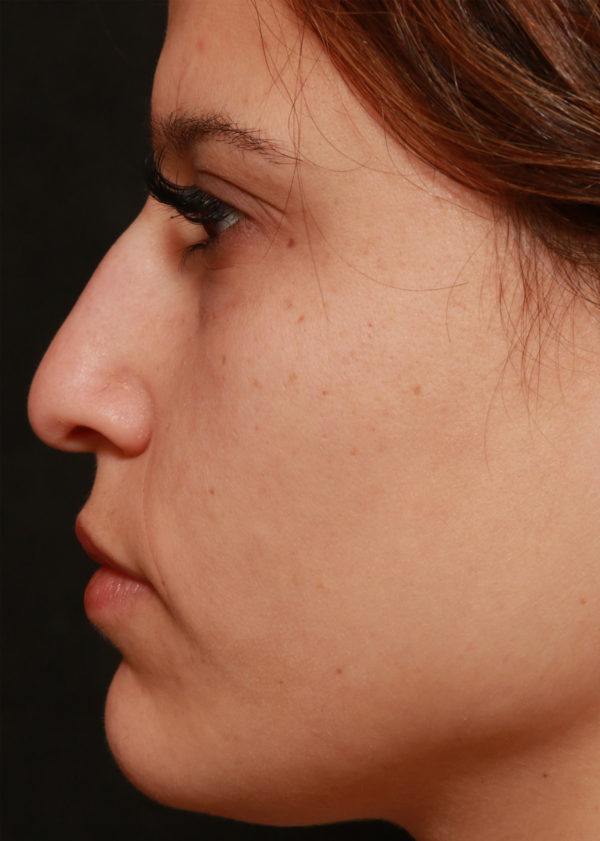 Non Surgical Nose Reshaping Before & After