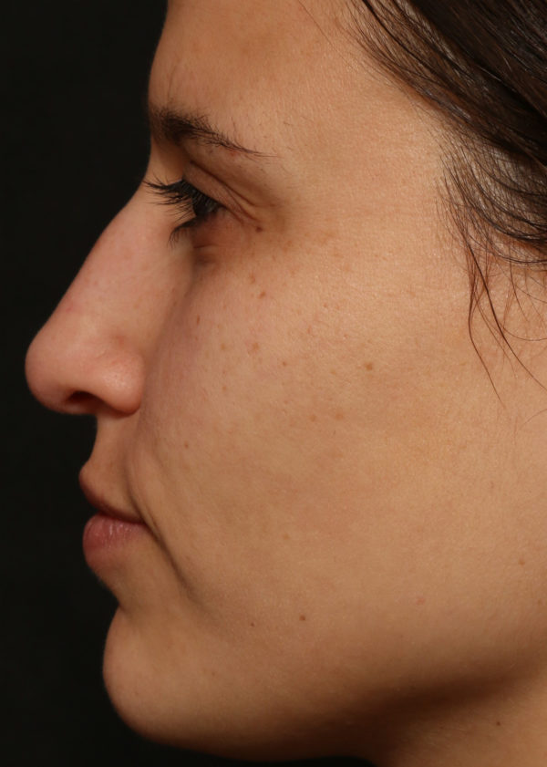Non Surgical Nose Reshaping Before & After