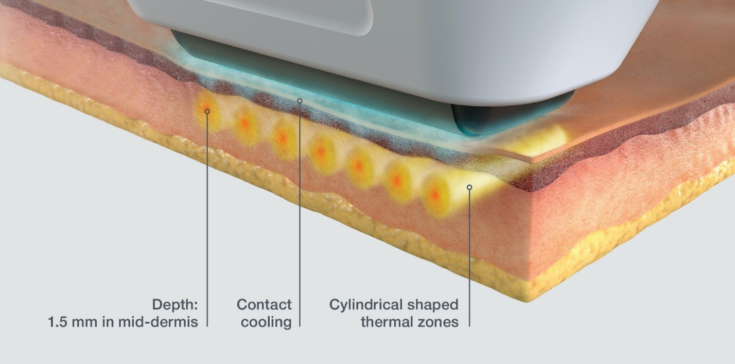 Sofwave Treatment