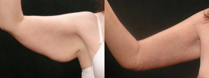 Real patient results before and after plastic surgery results in Glenview, IL, performed by Dr. Casas