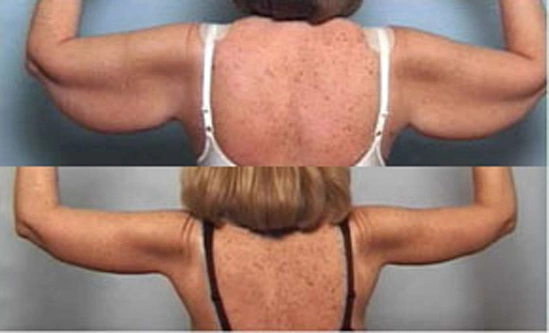 Real patient results before and after plastic surgery results in Glenview, IL, performed by Dr. Casas