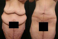 Real patient results before and after plastic surgery results in Glenview, IL, performed by Dr. Casas
