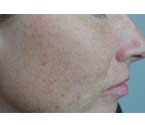 Laser Skin Treatment