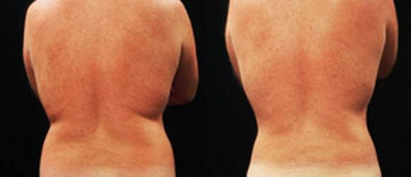 Real patient results before and after plastic surgery results in Glenview, IL, performed by Dr. Casas