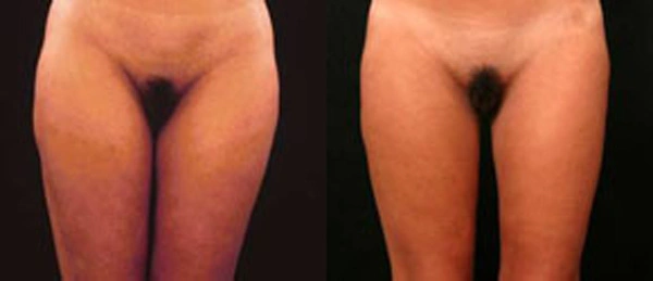 Real patient results before and after plastic surgery results in Glenview, IL, performed by Dr. Casas