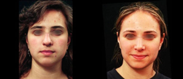 Real patient results before and after plastic surgery results in Glenview, IL, performed by Dr. Casas