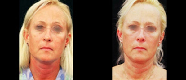 Real patient results before and after plastic surgery results in Glenview, IL, performed by Dr. Casas