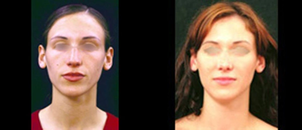 Real patient results before and after plastic surgery results in Glenview, IL, performed by Dr. Casas