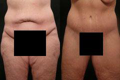 Real patient results before and after plastic surgery results in Glenview, IL, performed by Dr. Casas