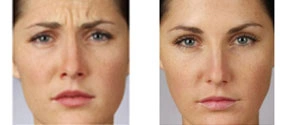 Real patient results before and after plastic surgery results in Glenview, IL, performed by Dr. Casas