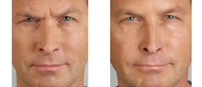 Real patient results before and after plastic surgery results in Glenview, IL, performed by Dr. Casas