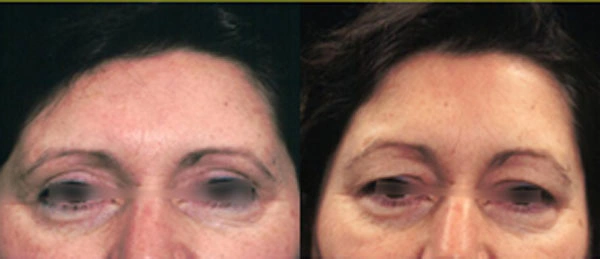 Real patient results before and after plastic surgery results in Glenview, IL, performed by Dr. Casas