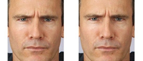 Real patient results before and after plastic surgery results in Glenview, IL, performed by Dr. Casas