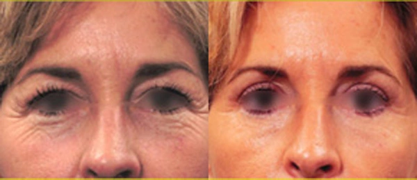 Real patient results before and after plastic surgery results in Glenview, IL, performed by Dr. Casas