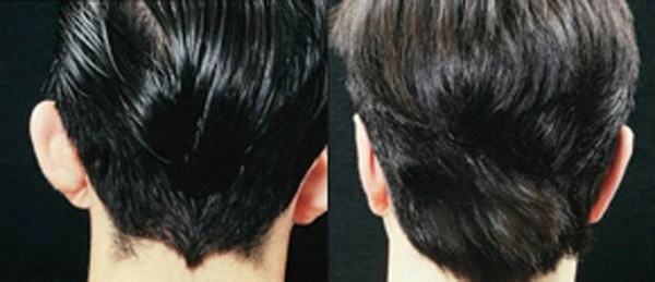 Real patient results before and after plastic surgery results in Glenview, IL, performed by Dr. Casas