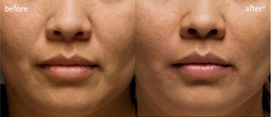 Real patient results before and after plastic surgery results in Glenview, IL, performed by Dr. Casas
