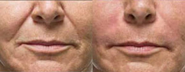 Real patient results before and after plastic surgery results in Glenview, IL, performed by Dr. Casas