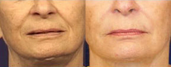Real patient results before and after plastic surgery results in Glenview, IL, performed by Dr. Casas