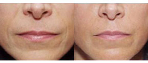 Real patient results before and after plastic surgery results in Glenview, IL, performed by Dr. Casas