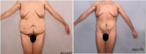 Real patient results before and after plastic surgery results in Glenview, IL, performed by Dr. Casas