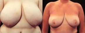 Real patient results before and after plastic surgery results in Glenview, IL, performed by Dr. Casas
