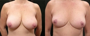 Real patient results before and after plastic surgery results in Glenview, IL, performed by Dr. Casas