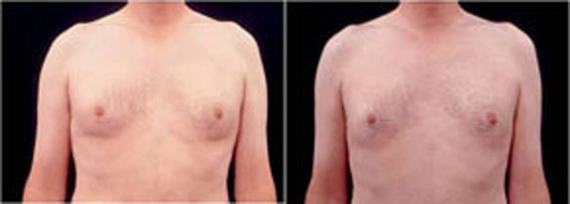Real patient results before and after plastic surgery results in Glenview, IL, performed by Dr. Casas