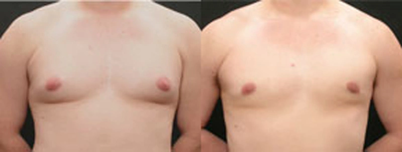 Real patient results before and after plastic surgery results in Glenview, IL, performed by Dr. Casas