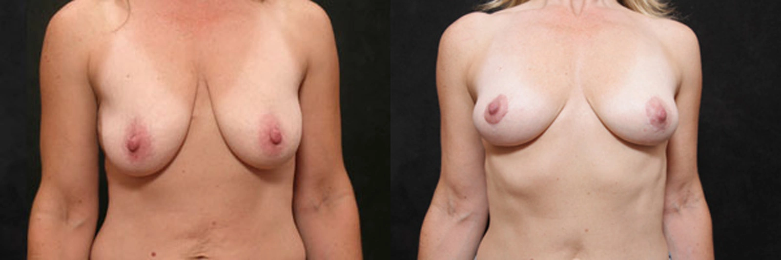 Real patient results before and after plastic surgery results in Glenview, IL, performed by Dr. Casas