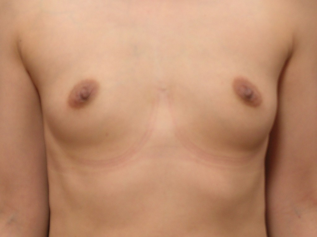Breast Augmentation