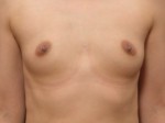 Breast Augmentation