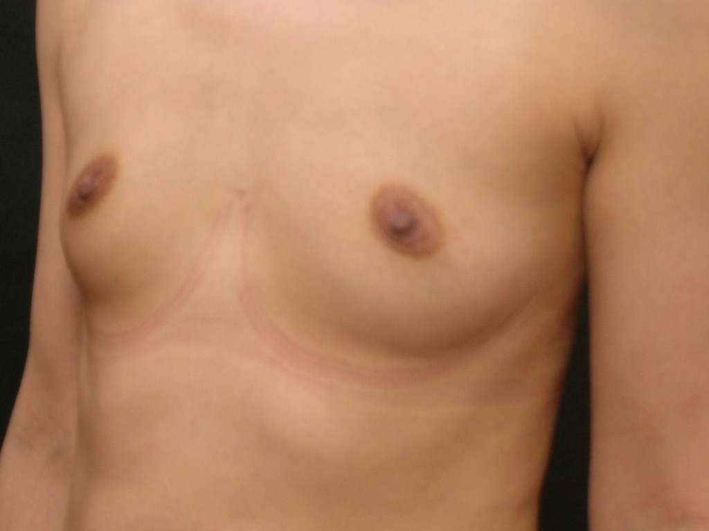 Breast Augmentation
