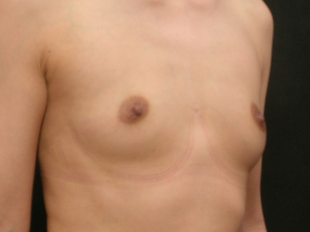 Breast Augmentation