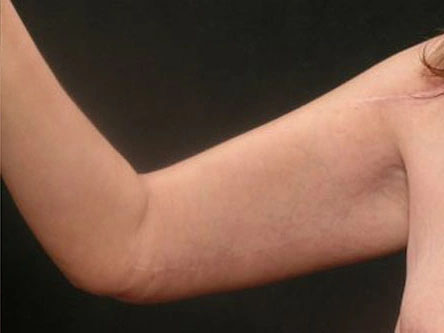 Real patient results before and after plastic surgery results in Glenview, IL, performed by Dr. Casas