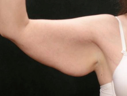 Real patient results before and after plastic surgery results in Glenview, IL, performed by Dr. Casas