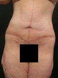 Real patient results before and after plastic surgery results in Glenview, IL, performed by Dr. Casas