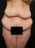Real patient results before and after plastic surgery results in Glenview, IL, performed by Dr. Casas