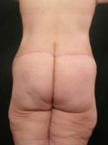 Real patient results before and after plastic surgery results in Glenview, IL, performed by Dr. Casas