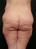 Real patient results before and after plastic surgery results in Glenview, IL, performed by Dr. Casas