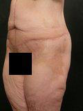 Real patient results before and after plastic surgery results in Glenview, IL, performed by Dr. Casas