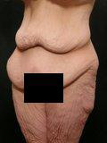Real patient results before and after plastic surgery results in Glenview, IL, performed by Dr. Casas