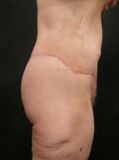 Real patient results before and after plastic surgery results in Glenview, IL, performed by Dr. Casas