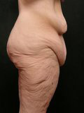 Real patient results before and after plastic surgery results in Glenview, IL, performed by Dr. Casas