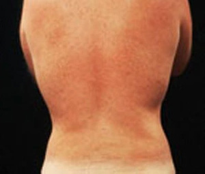 Real patient results before and after plastic surgery results in Glenview, IL, performed by Dr. Casas