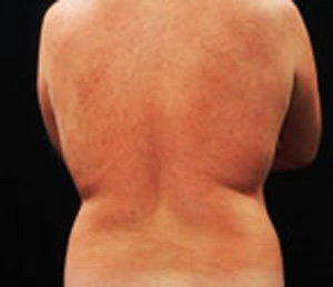 Real patient results before and after plastic surgery results in Glenview, IL, performed by Dr. Casas